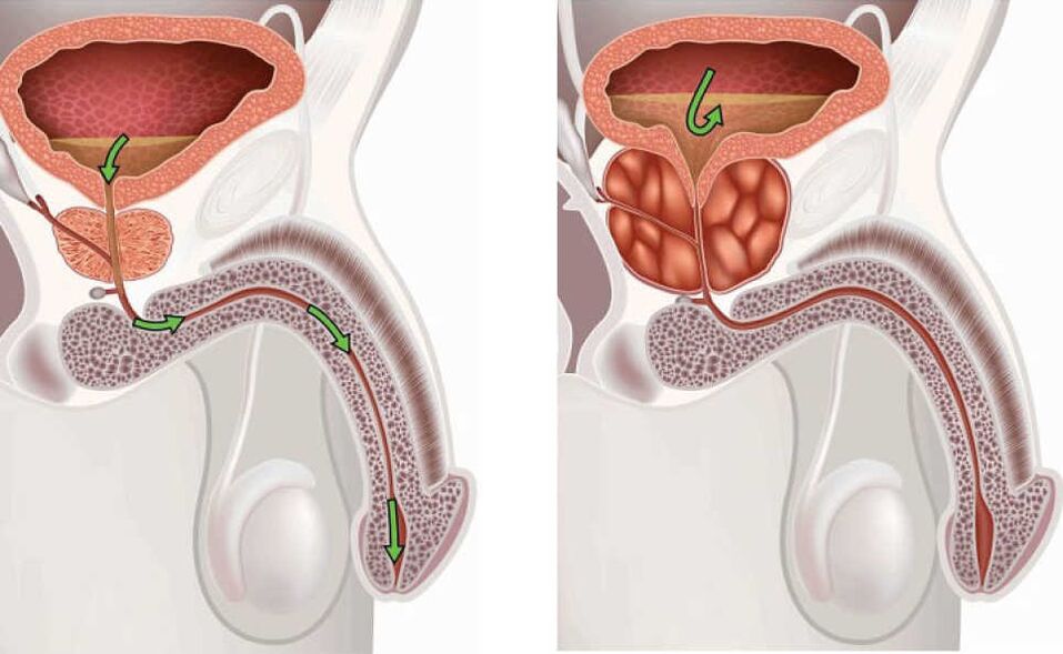 Inflammation de la glande de la prostate