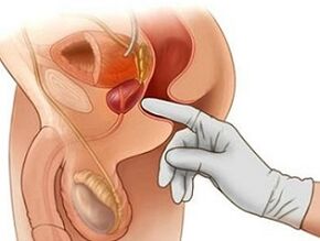 Massage de la prostate pour le traitement de la prostatite chez l'homme