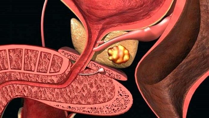 Dépôts de calculs dans la prostate avec prostatite calculeuse
