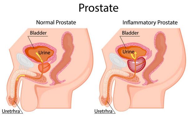 prostate saine et enflammée