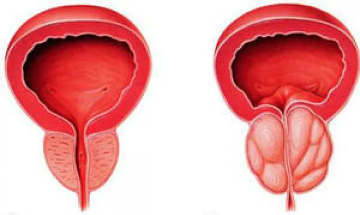 Prostate normale (à gauche) et prostatite chronique enflammée (à droite)