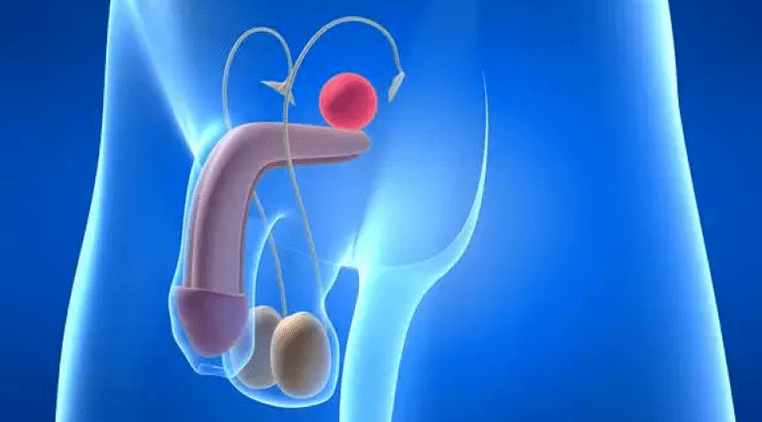 La prostatite est une inflammation de la prostate chez l'homme, nécessitant un traitement complexe